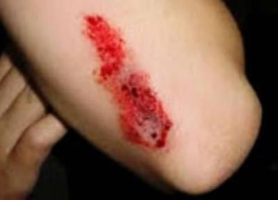 ترمیم زخم و تشکیل کلویید