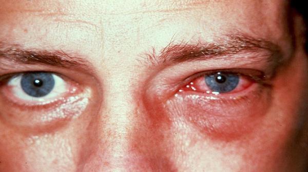 چگونه سرماخوردگی می تواند سلامت چشم را به خطر اندازد؟